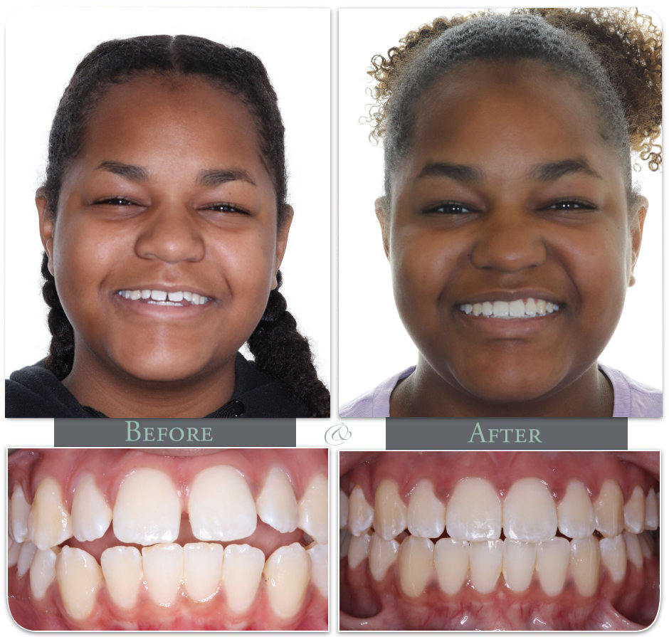 Showing Teath before after