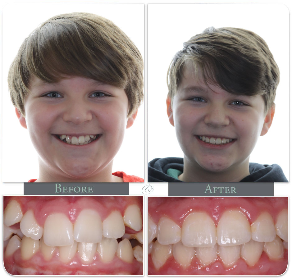 Kids showing his Teath before after