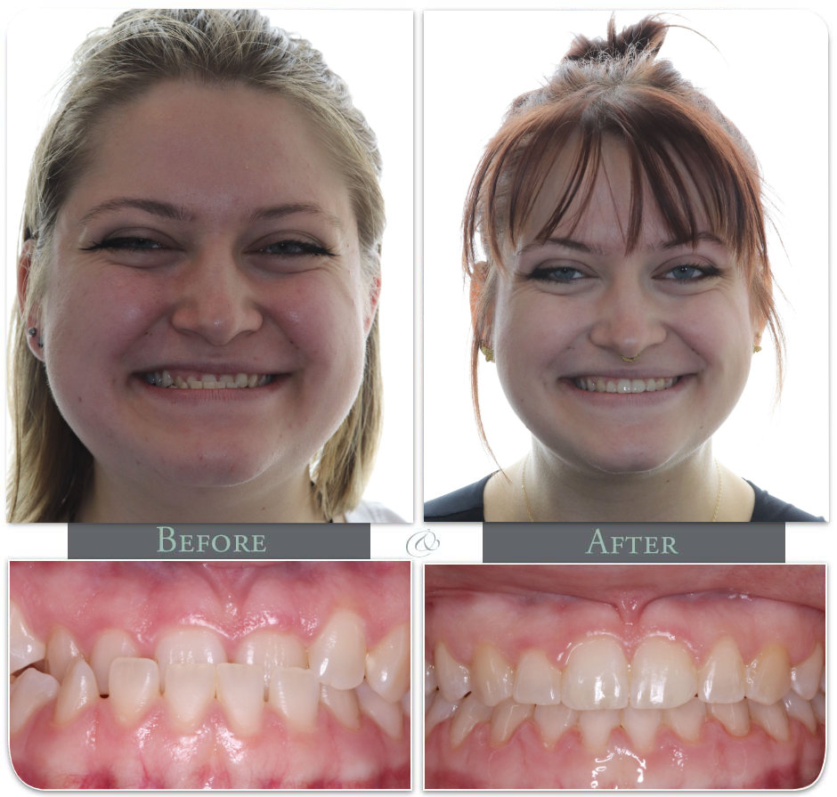 Showing Teath before after