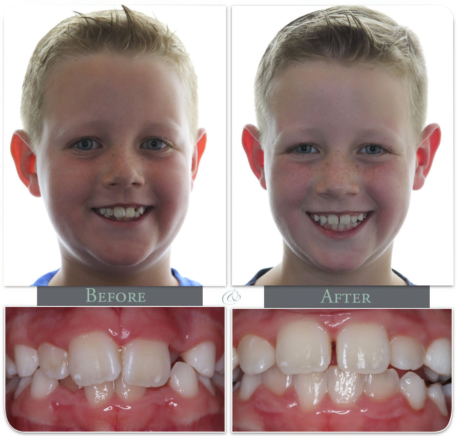 Showing Teath before after
