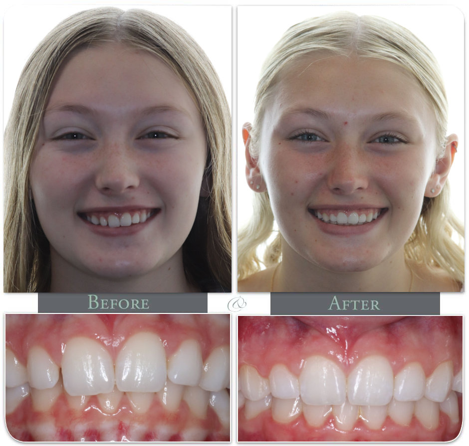 Showing Teath before after