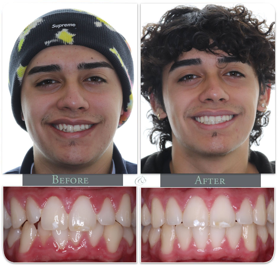 Showing Teath before after