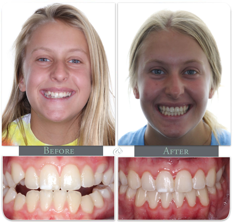 Showing Teath before after