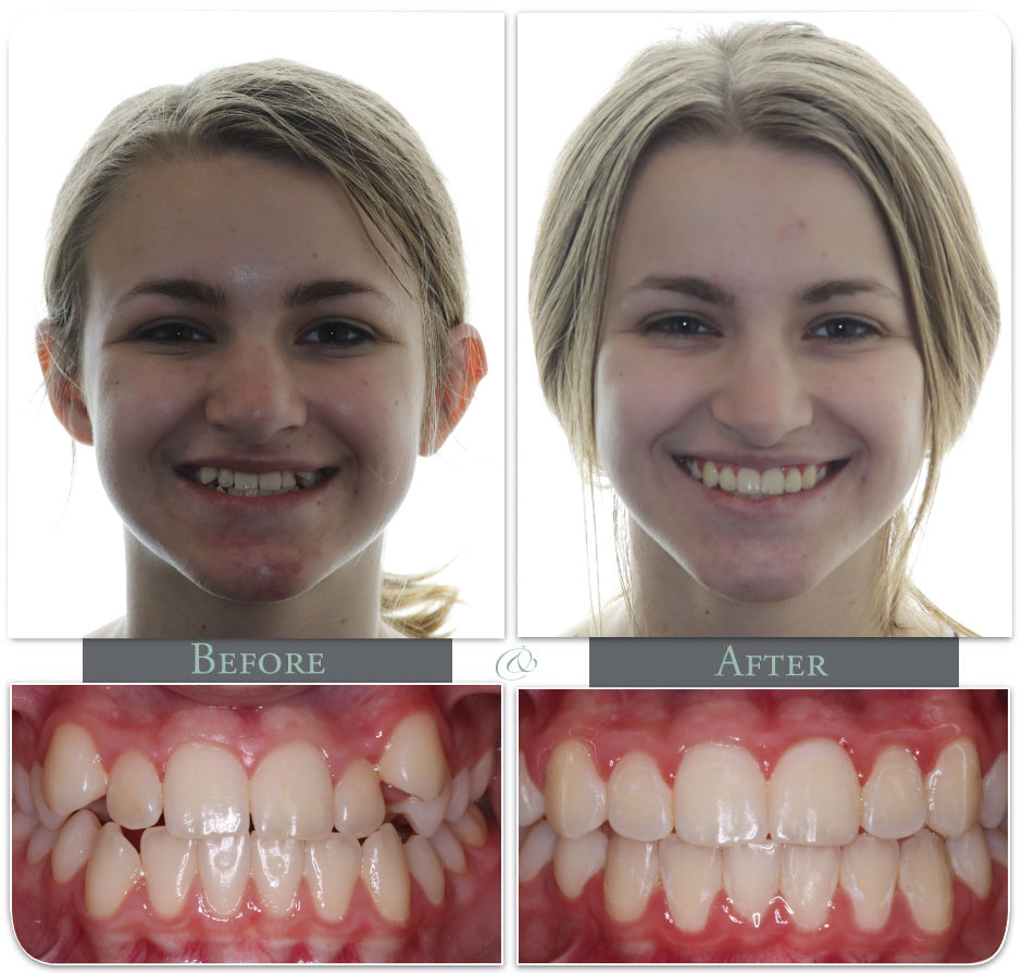 Showing Teath before after