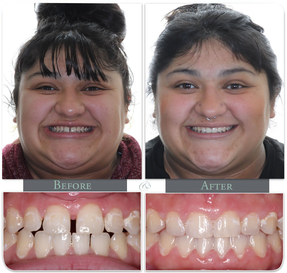 Showing Teath before after